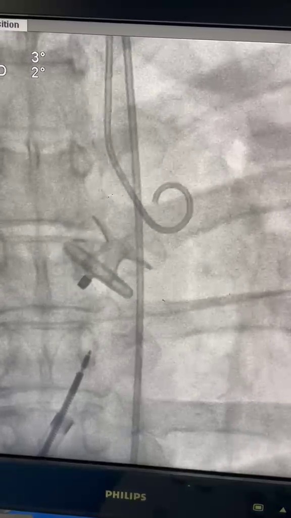 Atrial Flow Regulator Procedure Video