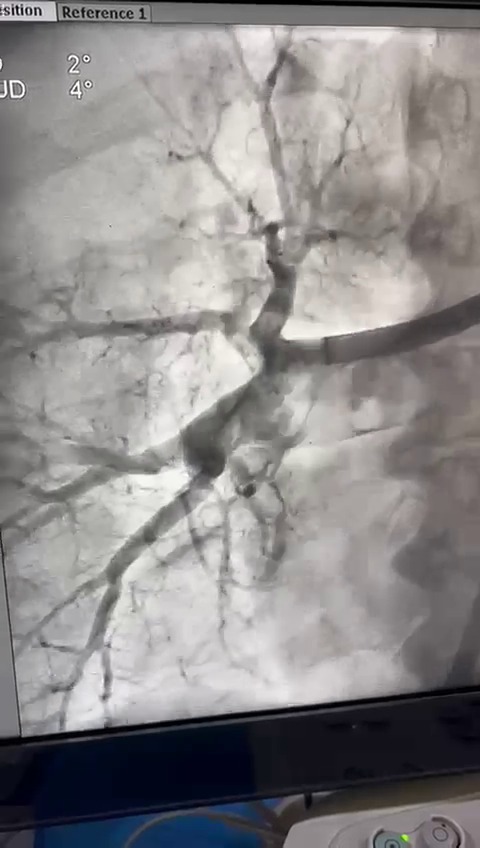 Pulmonary Thrombectomy Video 1