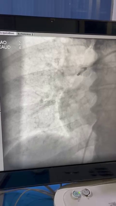 Pulmonary Thrombectomy Video 2