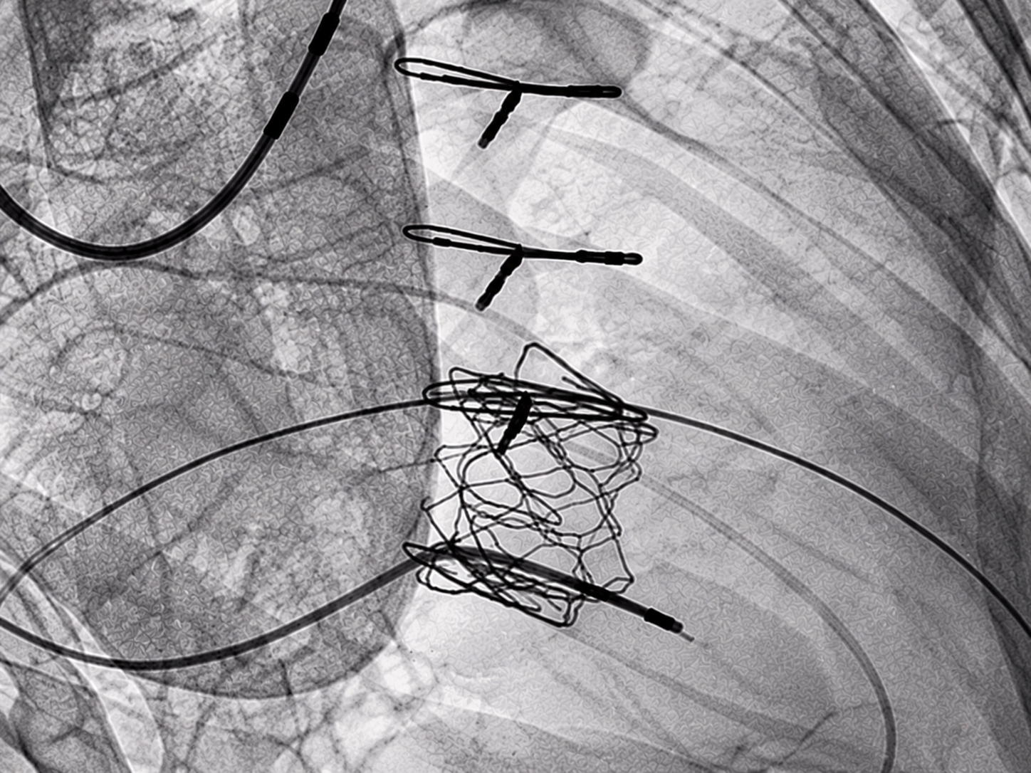 Valve-in-Valve TMVR Procedural Deployment