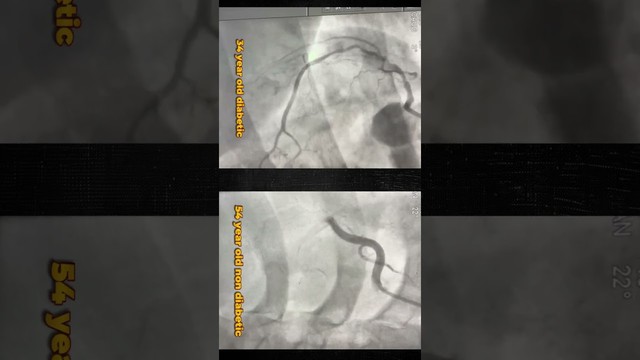 Difference in Heart Attack: Normal vs Diabetic Patient